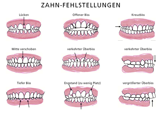 Zahnfehlstellungen - Copyright VÖK