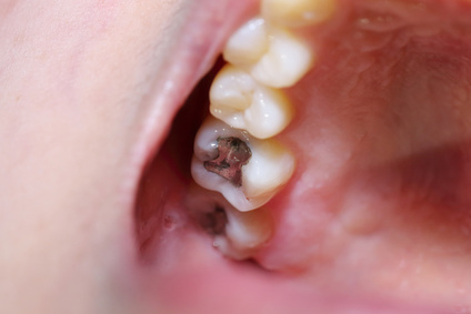 Amalgam - teeth cavity with the treatment
