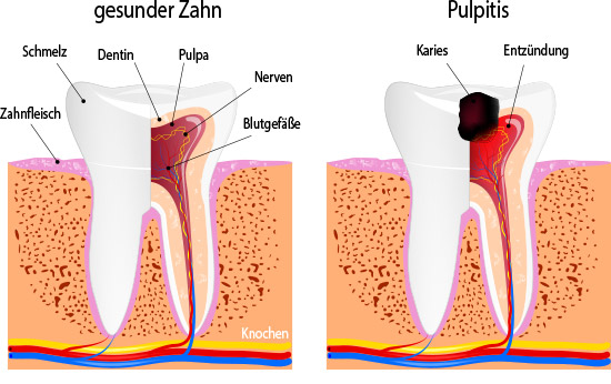 Pulpitis